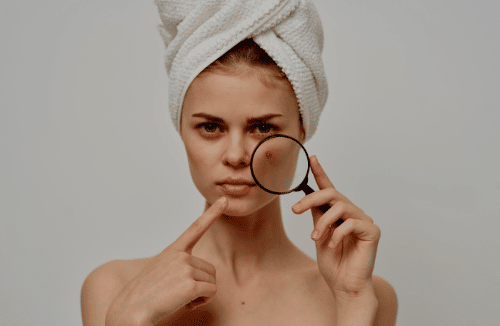 كريم فيوسيكورت لعلاج الالتهابات الجلدية البكتيرية و الحروق 10 حب الشاب