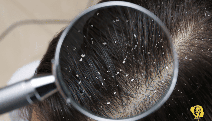 كيفية ازالة القشرة من الشعر 1 1