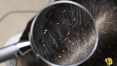كيفية ازالة القشرة من الشعر 1 1
