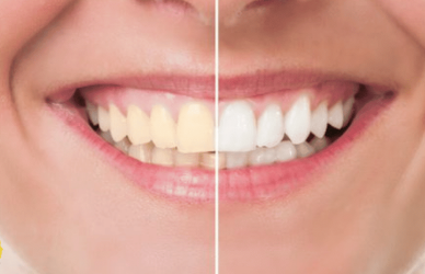 اسباب اصفرار الاسنان,اصفرار الاسنان,اسباب اصفرار الاسنان عند الاطفال,أسباب اصفرار الاسنان,علاج اصفرار الاسنان,اسباب اصفرار الاسنان بسرعة,وصفات لازالة اصفرار الاسنان,تبييض الاسنان,أسباب اصفرار الأسنان,أسباب اصفرار الأسنان اللبنية,أسباب اصفرار الأسنان المفاجئ,ما سبب اصفرار الاسنان,سبب اصفرار الاسنان,اسباب اصفرار الاسنان للاطفال,اسباب اصفرار الاسنان وعلاجها,اسباب صفار الاسنان,ازالة اصفرار الاسنان,ما هي أسباب اصفرار الأسنان,علاج اصفرار الأسنان